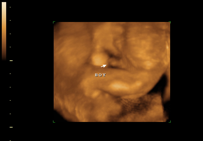 3D ultrasound image at 20 weeks